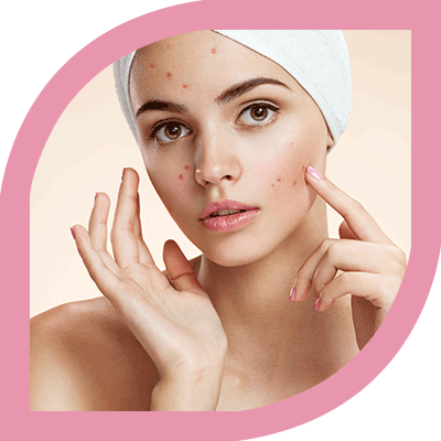 Best Acne Treatment Clinic in Delhi