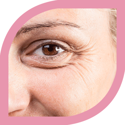 Best Botox Treatment for Wrinkle Removal