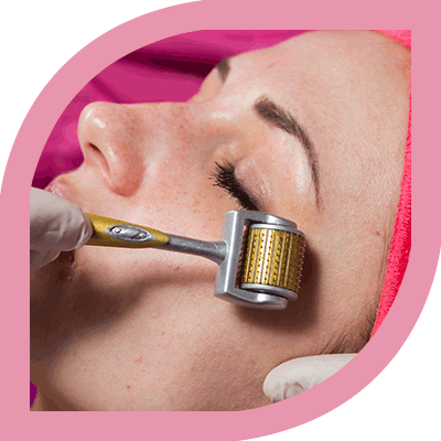 Best Dermaroller Treatment in Delhi