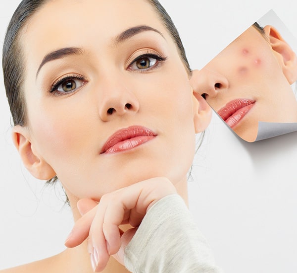 Best Pimple Treatment Clinic in Delhi